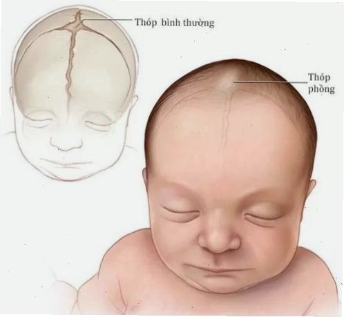 Thóp phồng ở trẻ sơ sinh có thể là dấu hiệu nguy hiểm
