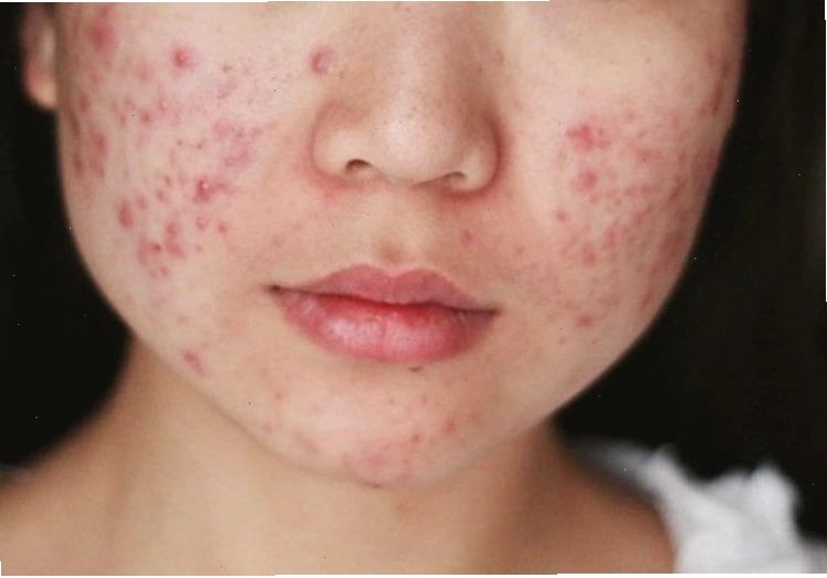 Thức khuya gây nổi mụn trứng cá và ảnh hưởng xấu đến làn da phái nữ