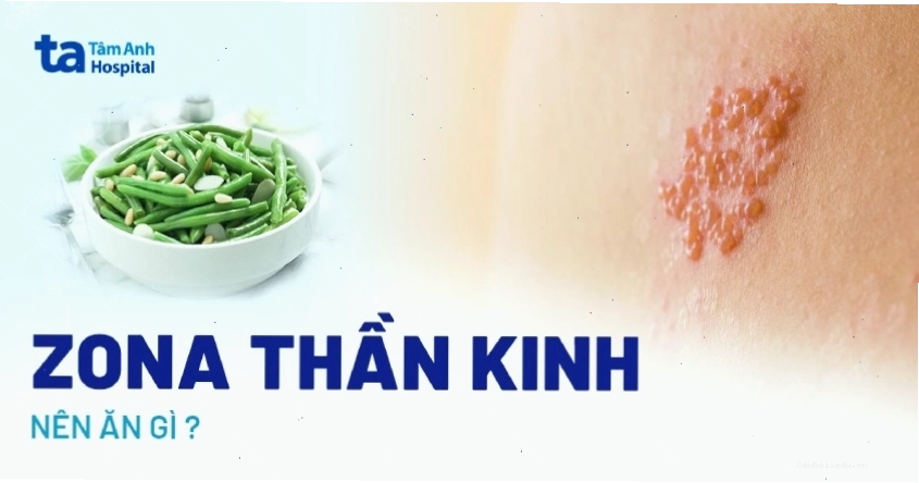 Thực phẩm nên ăn và nên kiêng khi bị zona thần kinh