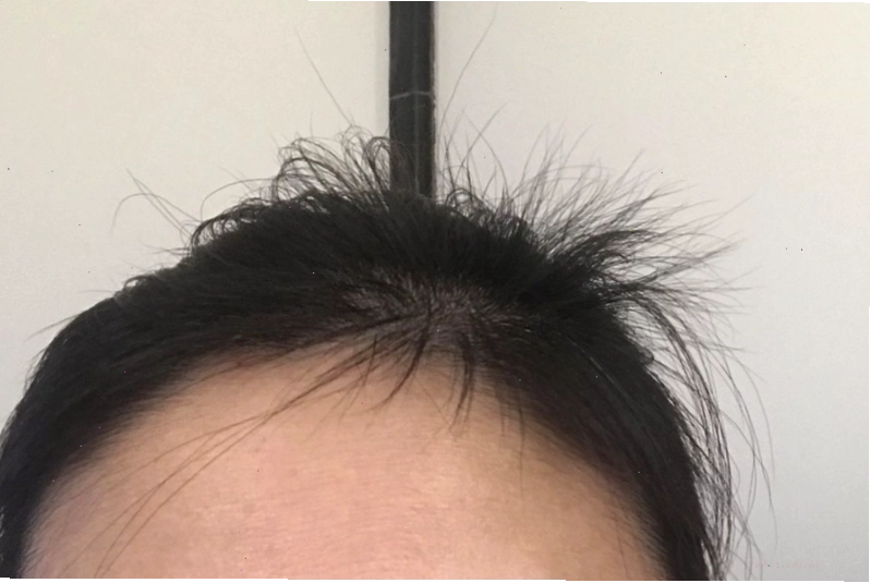 Tóc con mọc lởm chởm và các nguyên nhân phổ biến