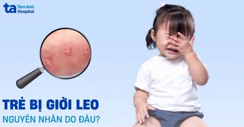 Trẻ bị giời leo: Hình ảnh, nguyên nhân, biểu hiện, phòng ngừa