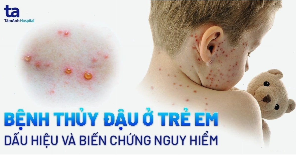 Trẻ em bị thủy đậu