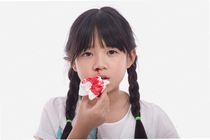Trẻ em thường hay bị chảy máu mũi hơn người lớn do cấu tạo niêm mạc mỏng manh