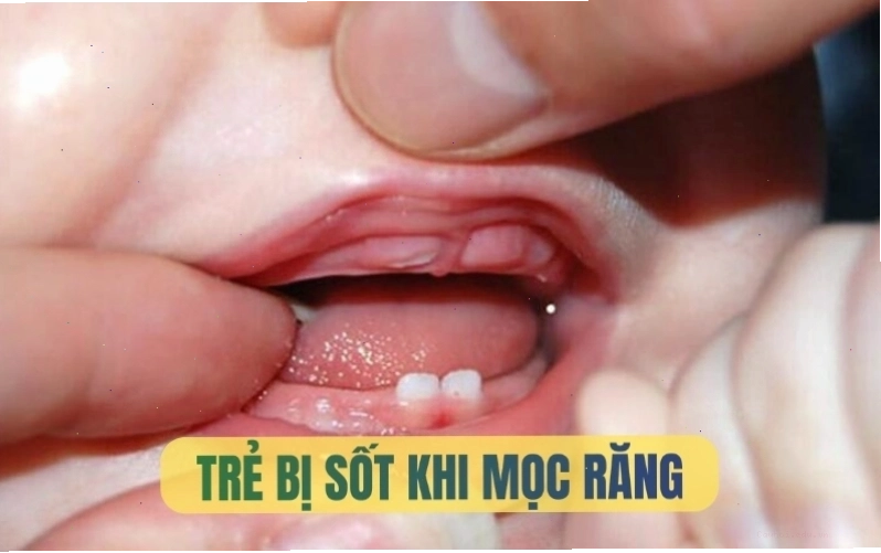 Trẻ sốt mọc răng và các vấn đề cần lưu ý