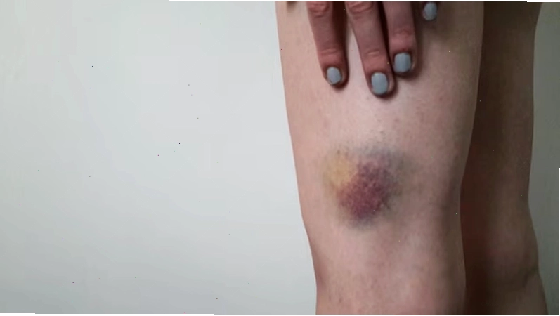 Trường hợp cần đi khám bác sĩ khi bị tụ máu dưới da