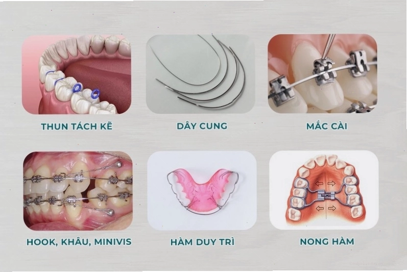 Vật liệu khí cụ niềng răng đảm bảo chất lượng