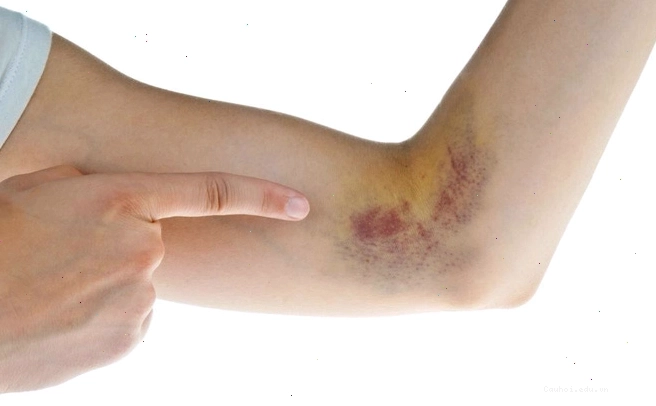 Vết bầm tím xuất hiện trên cánh tay do va đập