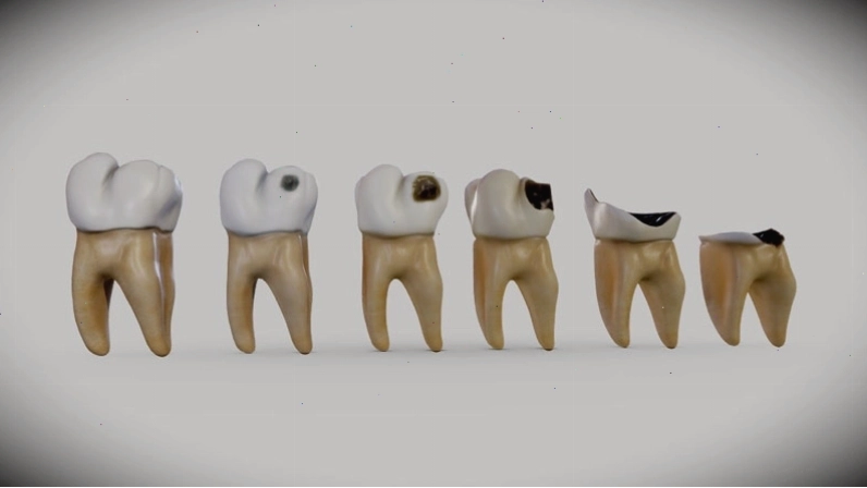Vi khuẩn tấn công men răng gây sâu răng