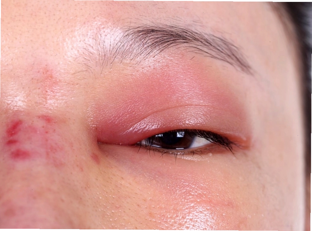 Viêm kết mạc gây sưng đỏ mắt