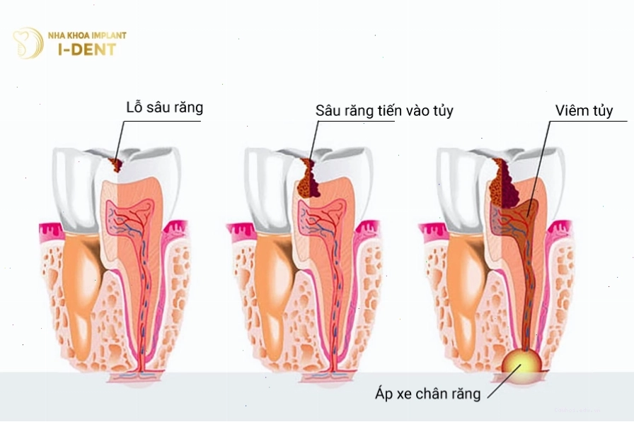 Viêm tủy răng do sâu răng nặng