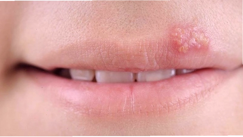 Virus gây bệnh giời leo là do tác nhân có tên gọi bọ giời