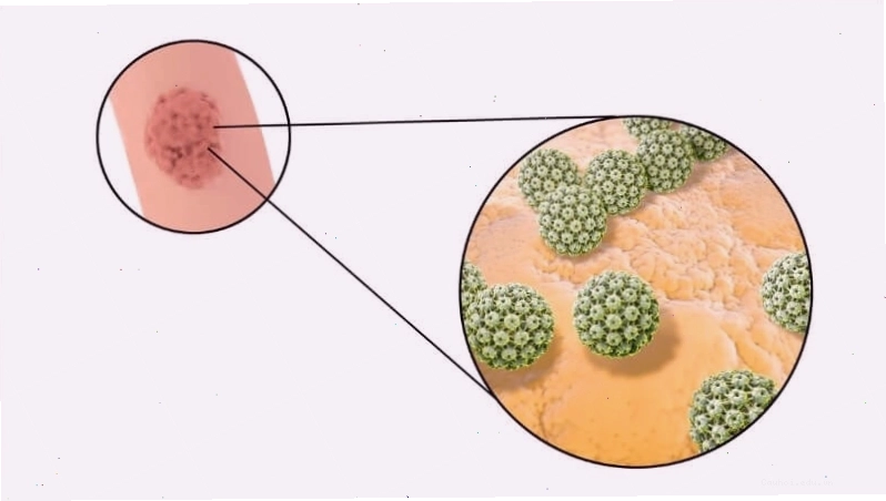 Virus HPV loại 6 và 11 thường gây ra sùi mào gà