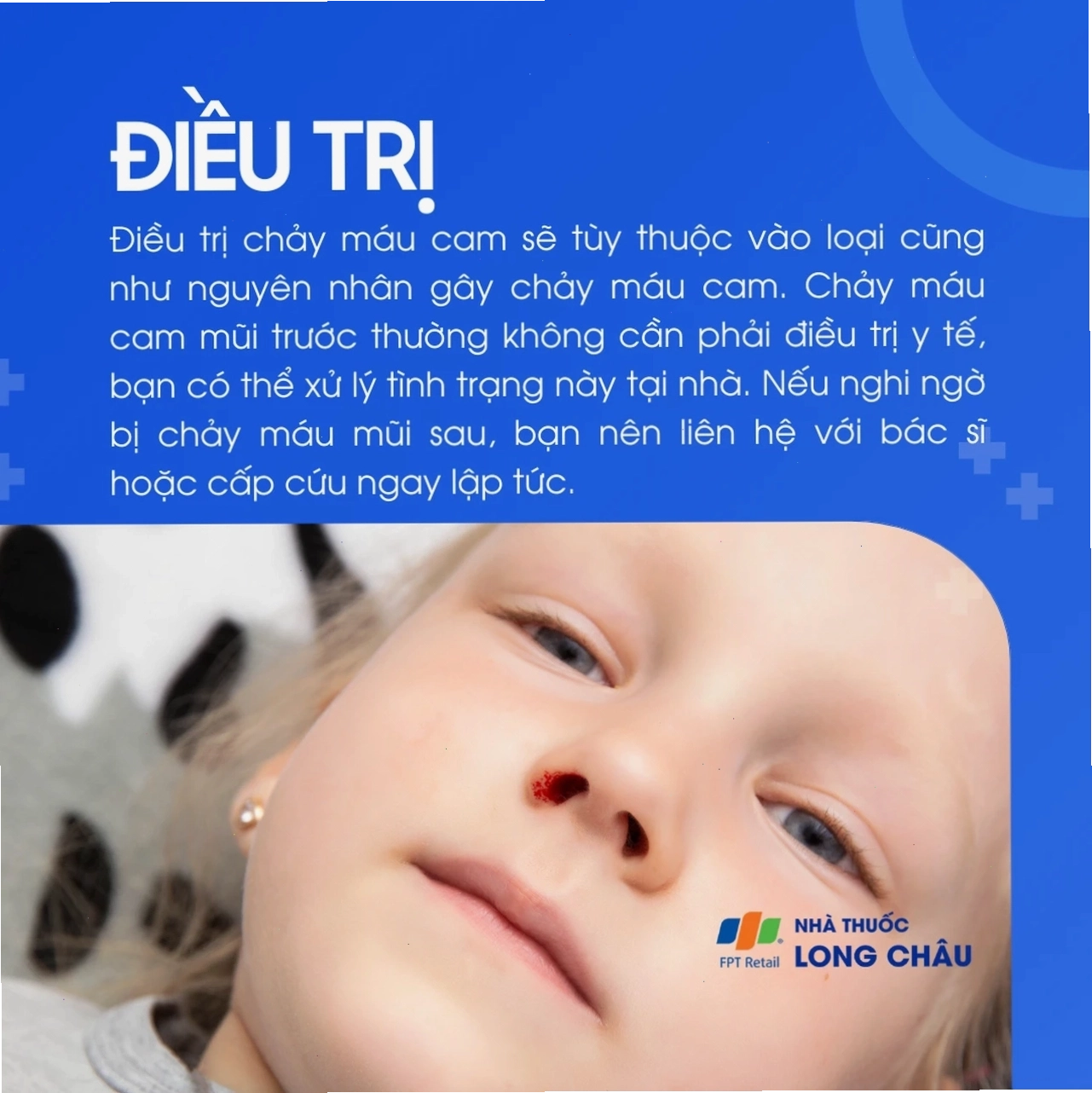 Với máu cam mũi trước, bạn có thể xử lý tại nhà. Máu mũi sau cần khám ngay nếu nghi ngờ nặng