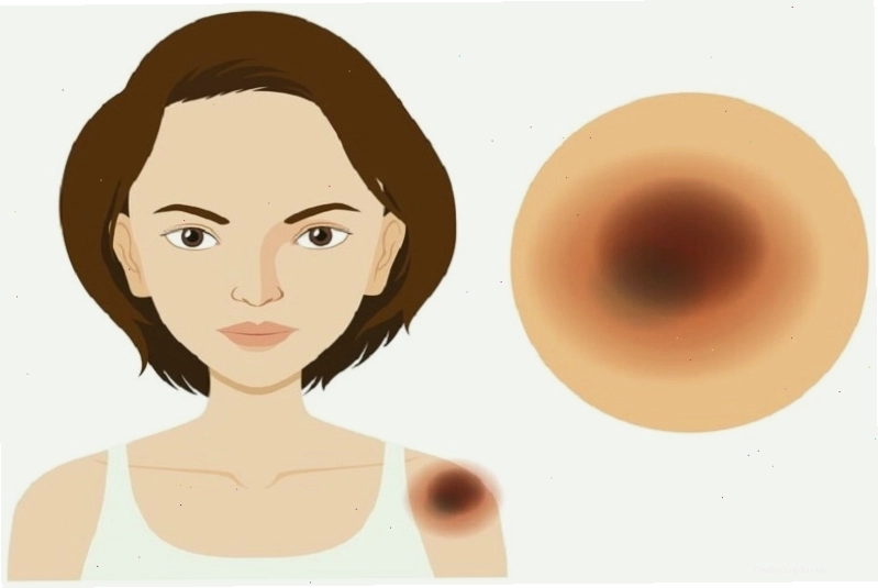 Vùng da bị xây xát sâu có thể dẫn đến hoại tử