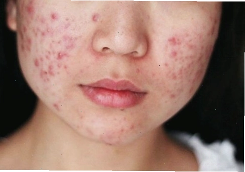Da mụn viêm gây ra tình trạng da có có vết thâm đỏ và sưng