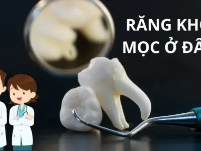 Răng khôn mọc ở đâu? Bí mật vị trí mọc "khó ưa" này