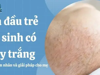 Da đầu trẻ sơ sinh có vảy trắng - Nguyên nhân và giải pháp cho mẹ