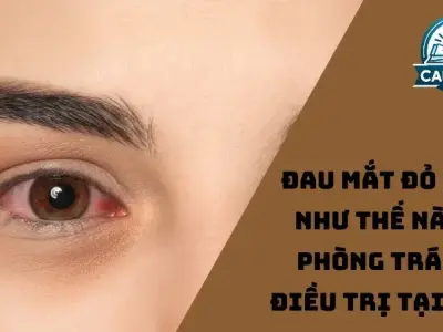 Đau mắt đỏ lây như thế nào? Phòng tránh điều trị tại nhà
