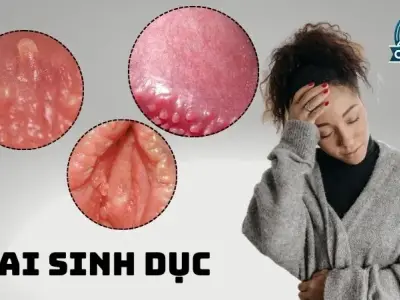 Gai sinh dục như thế nào? Cách phát hiện gai sinh dục