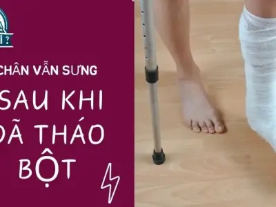 Tại sao chân vẫn sưng sau khi tháo bột? Các biện pháp điều trị hiệu quả