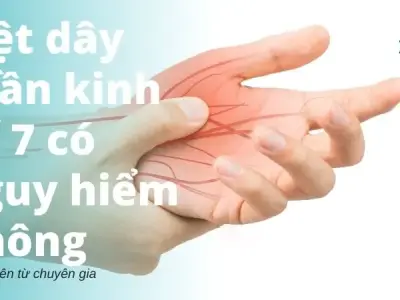 Liệt dây thần kinh số 7 có nguy hiểm không?
