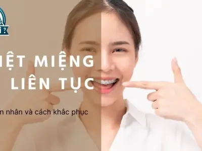 Làm như thế nào để ngăn chặn tình trạng nhiệt miệng liên tục?