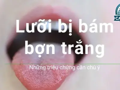 Tại sao lưỡi đóng bợn trắng? Những triệu chứng cần chú ý 