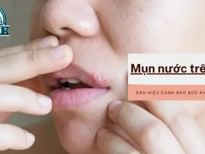Mụn nước trên môi -Dấu hiệu cảnh báo sức khỏe bạn cần biết