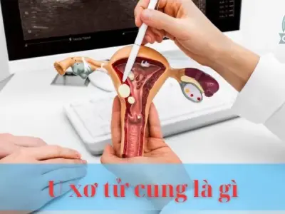 U xơ tử cung là gì : Cách nhận biết khi có triệu trứng