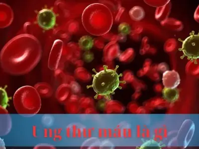 Bệnh ung thư máu là gì: Triệu chứng và cách điều trị hiệu
