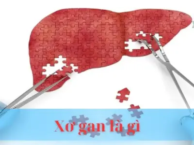 Bệnh Xơ gan: Và cách phòng ngừa hiệu quả