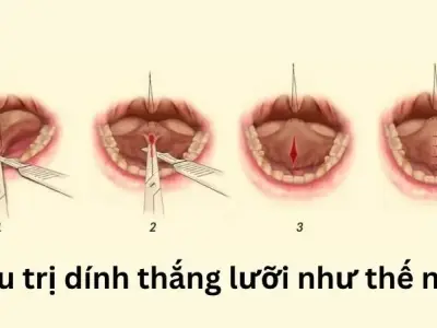 Như thế nào là dính thắng lưỡi? Tìm hiểu nguyên nhân, dấu hiệu và cách điều trị