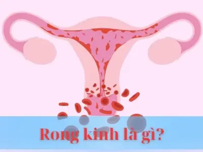 Rong kinh là gì? Giải mã hiện tượng chảy máu bất thường ở phụ nữ