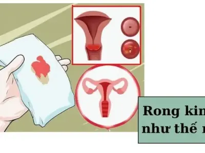 Rong kinh - Nguyên nhân và cách điều trị khi rong kinh như thế nào