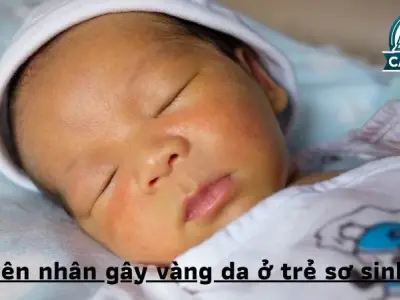 Nguyên nhân gây vàng da ở trẻ sơ sinh- Giải đáp chi tiết