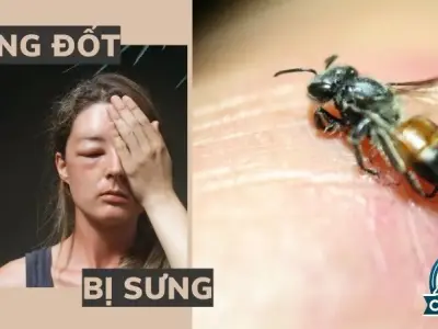 Tại sao ong đốt gây sưng và cách xử lý vết ong đốt hiệu quả