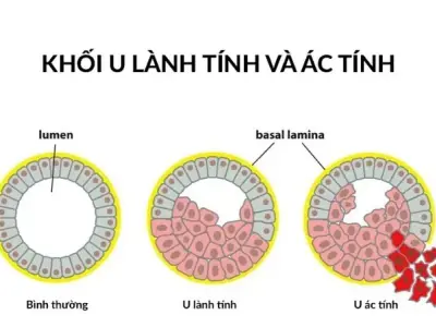 U ác tính khác u lành như thế nào? Cách nhận biết khối u sớm