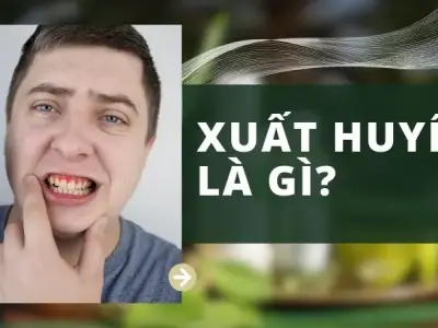 Xuất huyết nguy hiểm như thế nào? Dấu hiệu cảnh báo