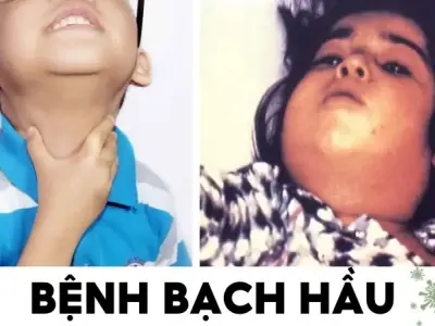 Bệnh bạch hầu là gì? Tại sao lại có đợt bùng phát bệnh bạch hầu mới?