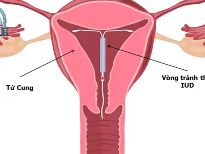 Những tác hại đặt vòng tránh thai đối với sức khỏe phụ nữ