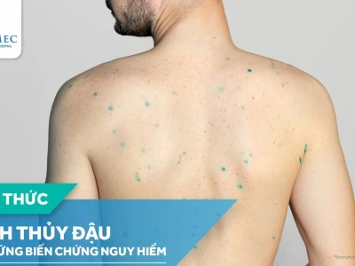 Bị thủy đậu như thế nào? Nguyên nhân, triệu chứng và cách xử lý hiệu quả