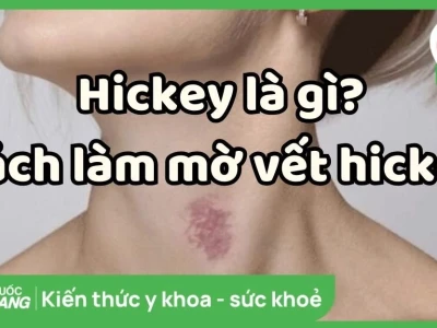 Cách làm mờ vết hickey nhanh nhất: Bí quyết và Lời khuyên từ chuyên gia