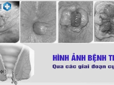 Cục Trĩ Như Thế Nào? Nhận Biết Dấu Hiệu và Cách Xử Lý Hiệu Quả Năm 2026