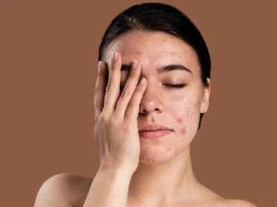 Da nhạy cảm là gì? Cách chăm sóc da khỏe hơn mỗi ngày