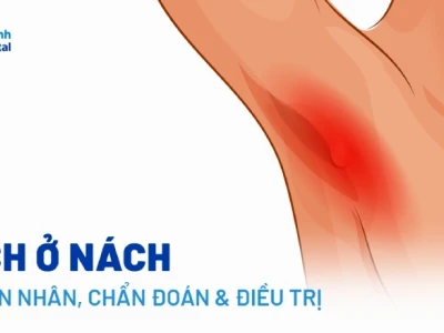Hạch sữa ở nách: Nguyên nhân, cách làm tan và phòng ngừa hiệu quả