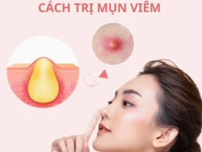 Mụn viêm là gì? Nguyên nhân, dấu hiệu và cách xử lý hiệu quả