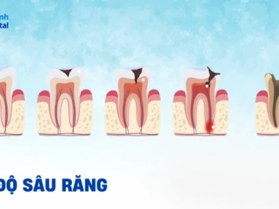 Răng Sâu Độ 3 Là Như Thế Nào? Dấu Hiệu, Tác Hại Và Cách Điều Trị