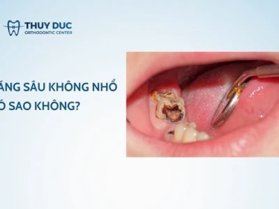 Tác hại khôn lường khi không nhổ răng sâu