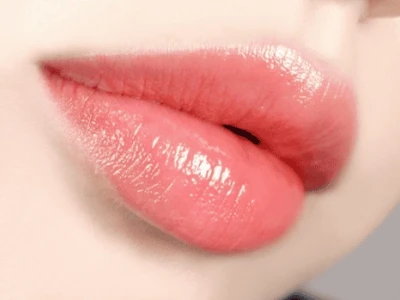 Tác hại tiềm ẩn của phun môi collagen và cách khắc phục
