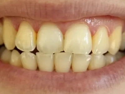Tại sao đánh răng thường xuyên mà răng vẫn vàng?